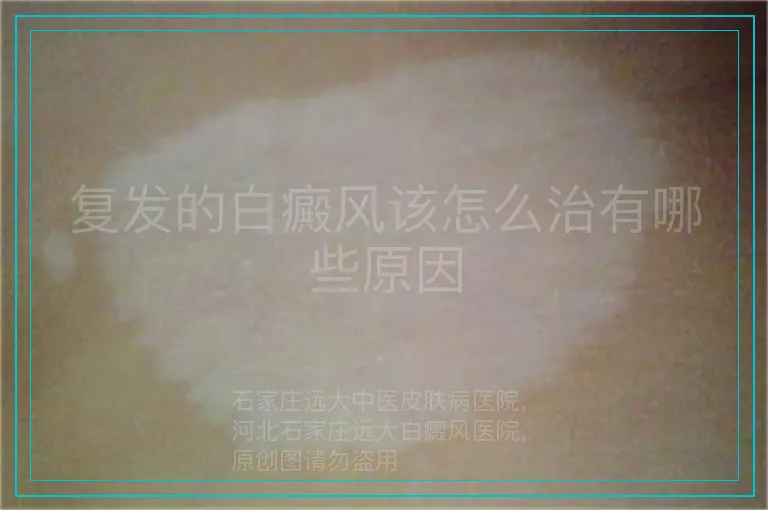 复发的白癜风该怎么治有哪些原因