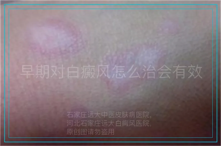 早期对白癜风怎么治会有效