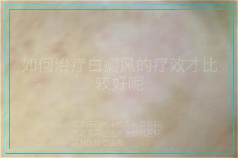 如何治疗白癜风的疗效才比较好呢