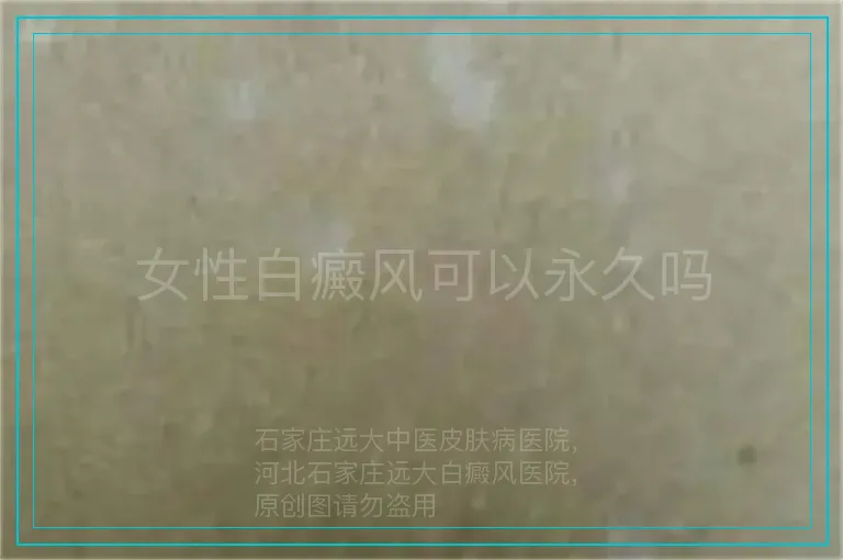 女性白癜风可以永久吗