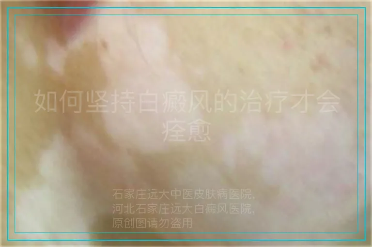 如何坚持白癜风的治疗才会痊愈