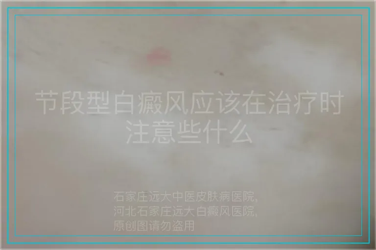 节段型白癜风应该在治疗时注意些什么