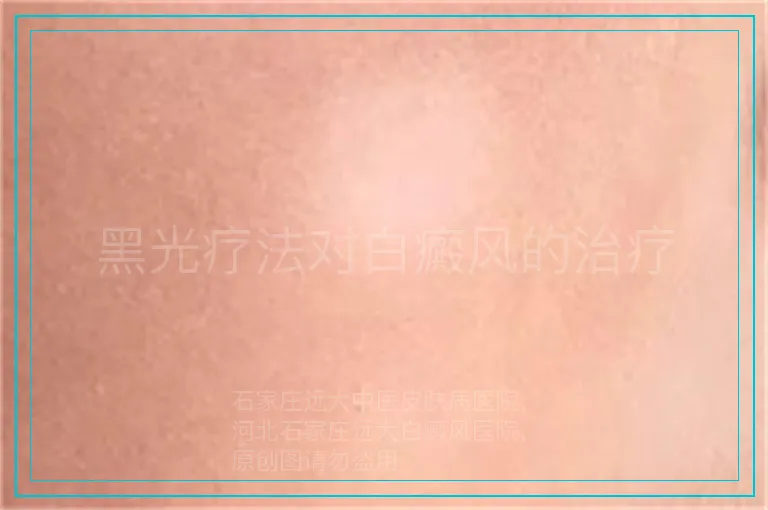 黑光疗法对白癜风的治疗