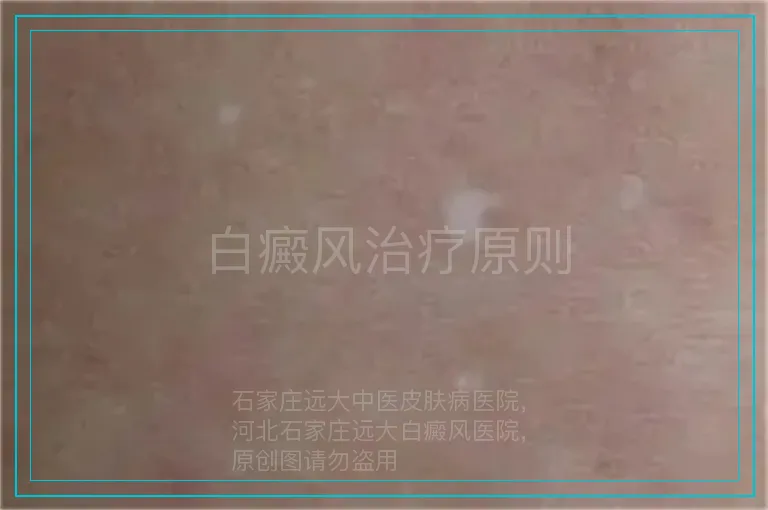 白癜风治疗原则