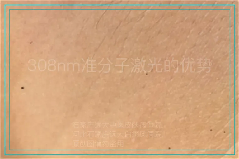308nm准分子激光的优势