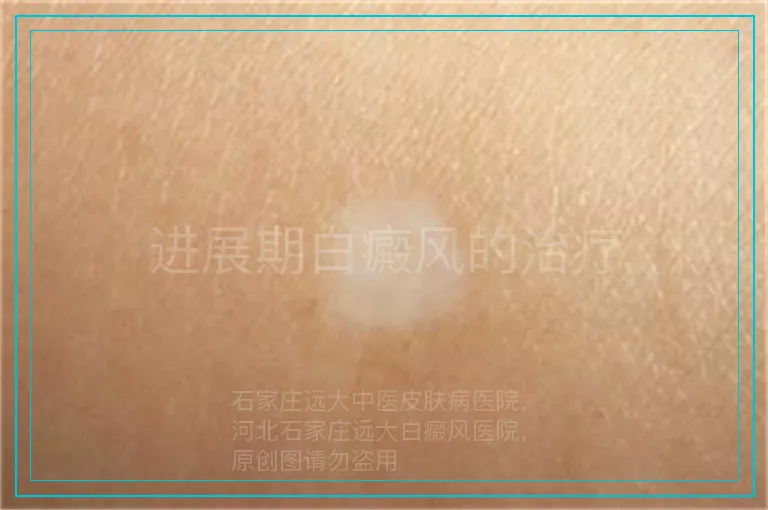 进展期白癜风的治疗