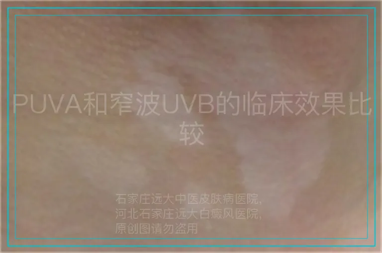PUVA和窄波UVB的临床效果比较