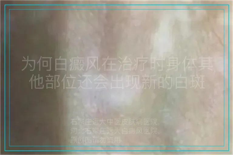 为何白癜风在治疗时身体其他部位还会出现新的白斑