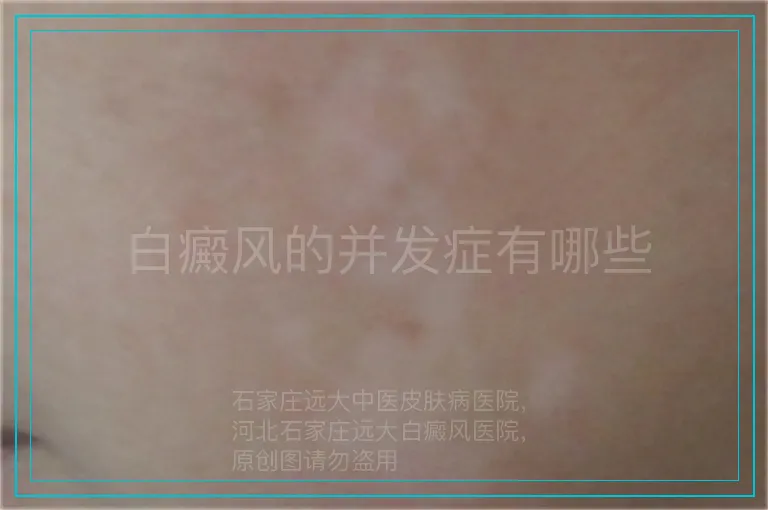白癜风的并发症有哪些
