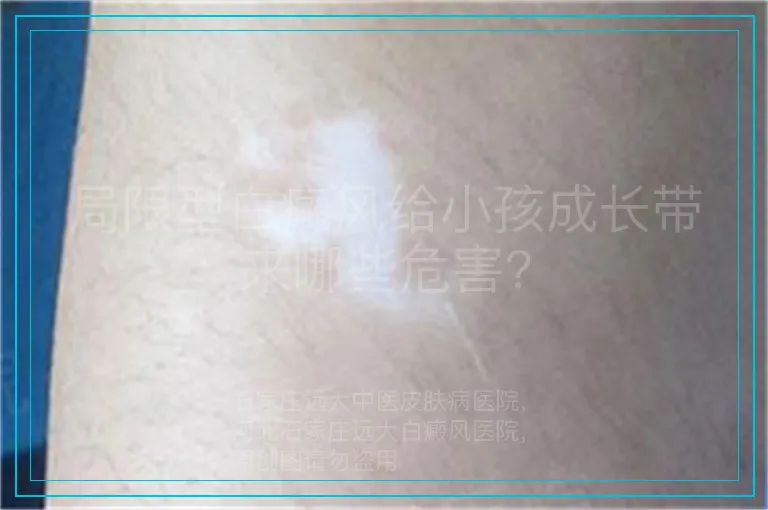 局限型白癜风给小孩成长带来哪些危害?