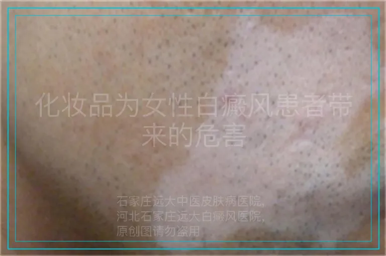 化妆品为女性白癜风患者带来的危害