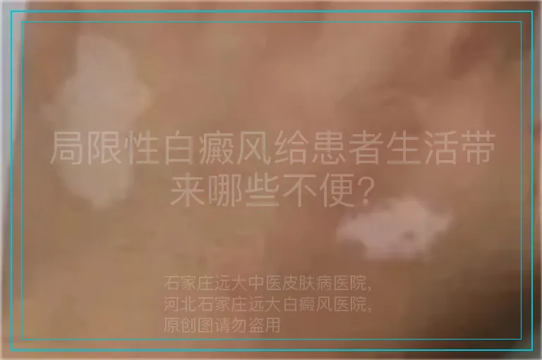 局限性白癜风给患者生活带来哪些不便?