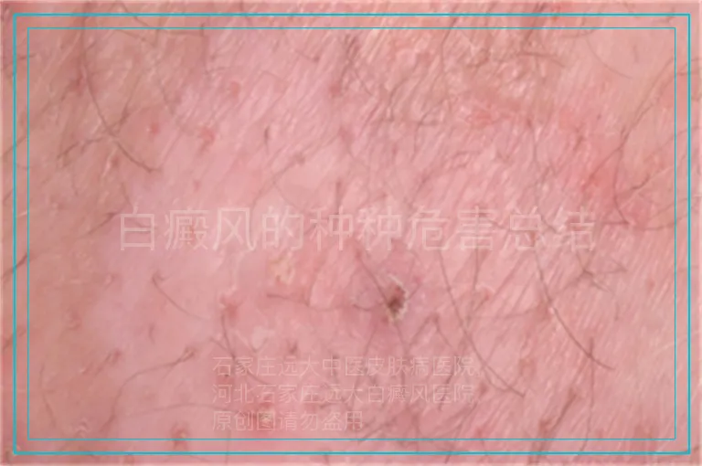 白癜风的种种危害总结