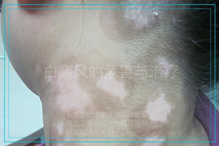 白癜风的危害与治疗