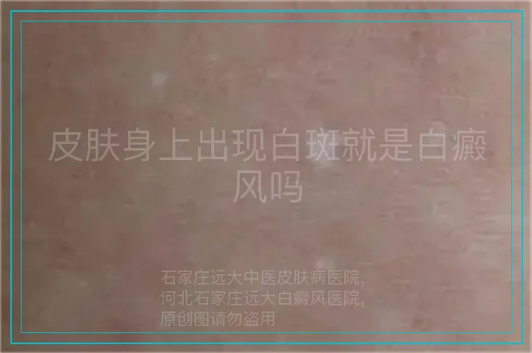 皮肤身上出现白斑就是白癜风吗