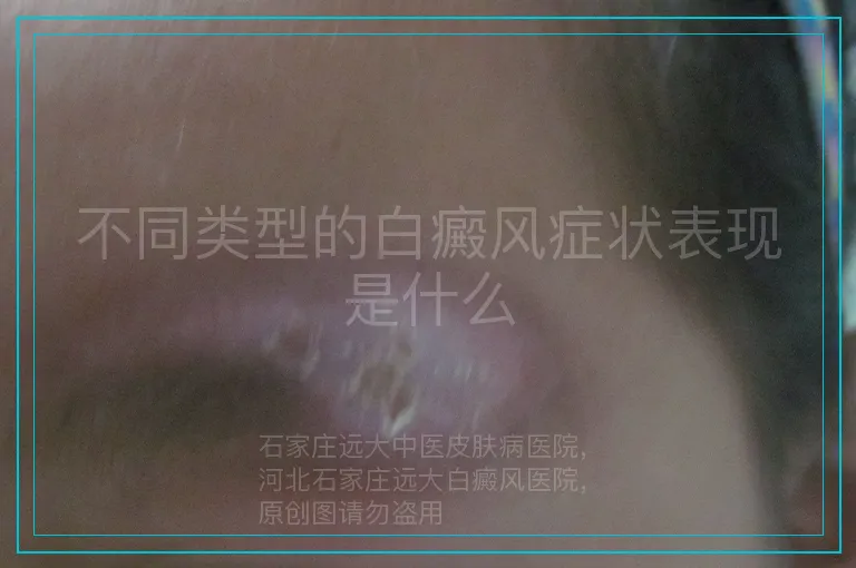 不同类型的白癜风症状表现是什么