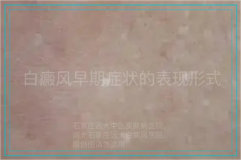 白癜风早期症状的表现形式