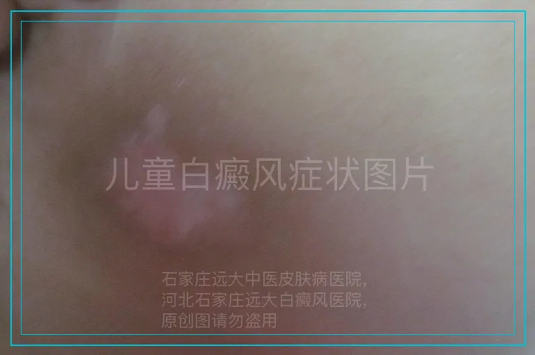 儿童白癜风症状图片