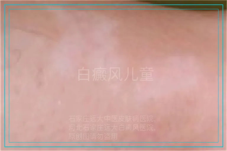 白癜风儿童