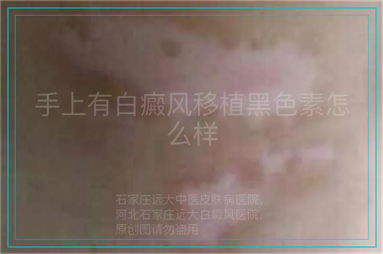 手上有白癜风移植黑色素怎么样