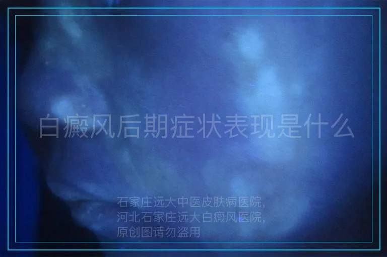 白癜风后期症状表现是什么