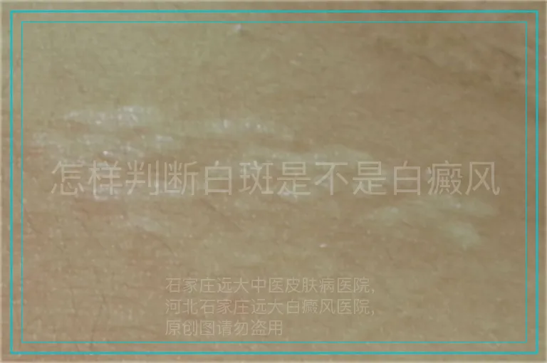 怎样判断白斑是不是白癜风