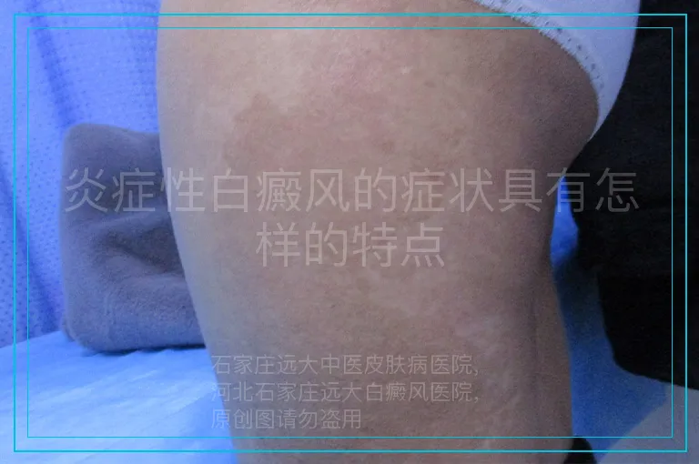 炎症性白癜风的症状具有怎样的特点