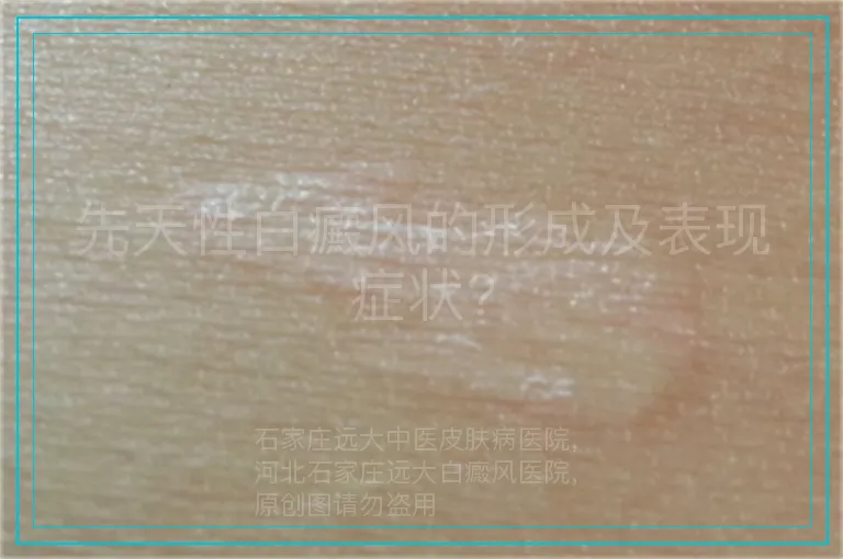 先天性白癜风的形成及表现症状?