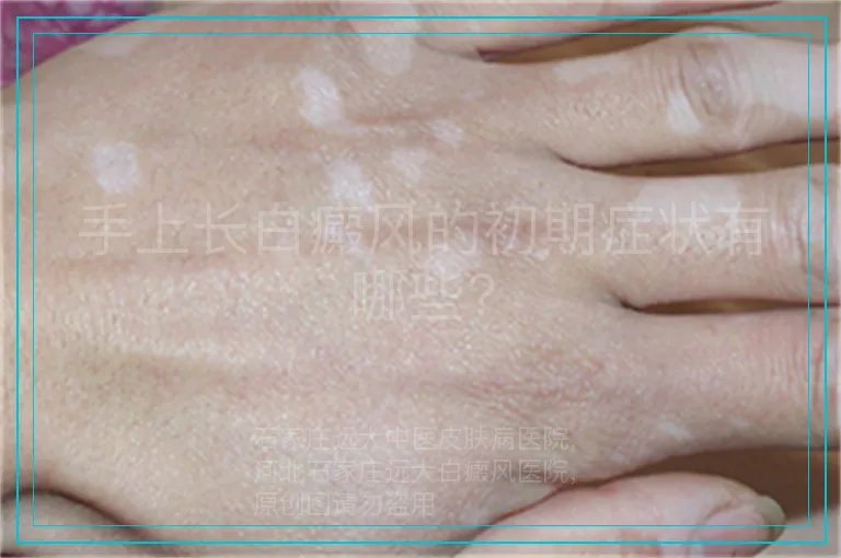 手上长白癜风的初期症状有哪些?