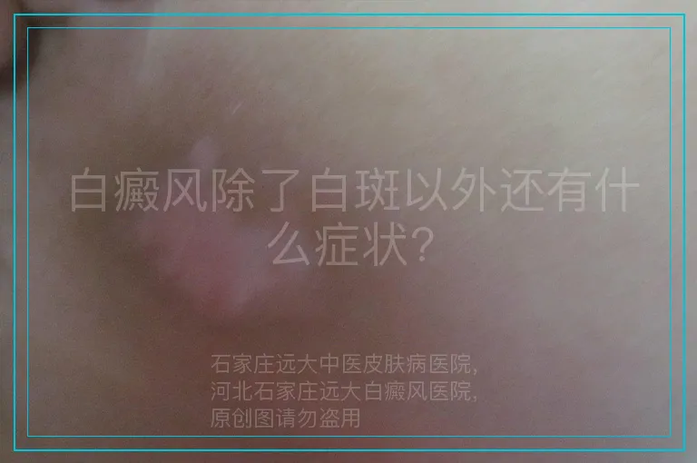 白癜风除了白斑以外还有什么症状?