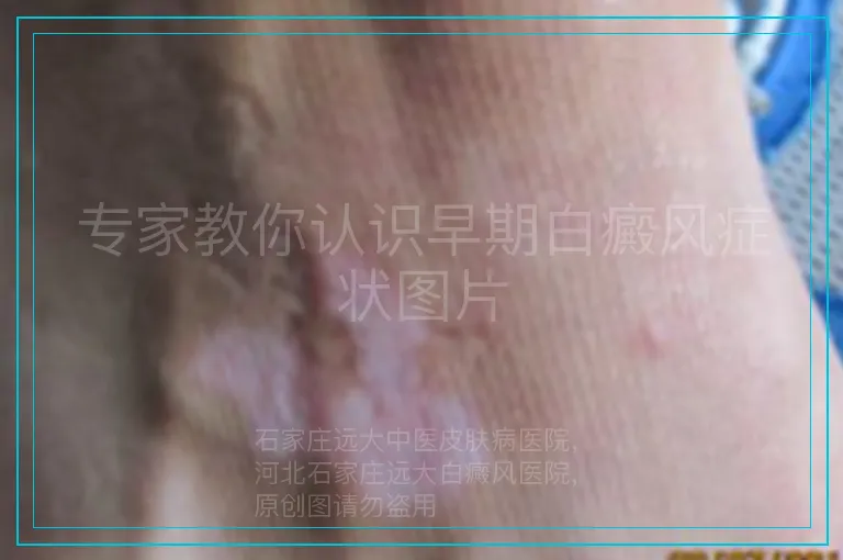 专家教你认识早期白癜风症状图片