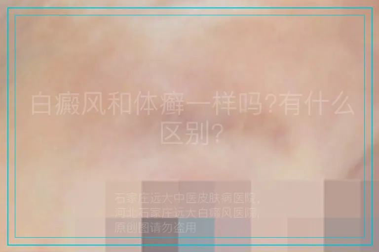白癜风和体癣一样吗?有什么区别?