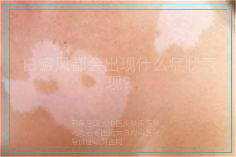 白癜风都会出现什么症状表现?