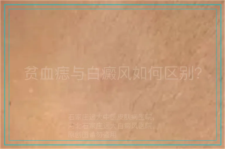 贫血痣与白癜风如何区别？