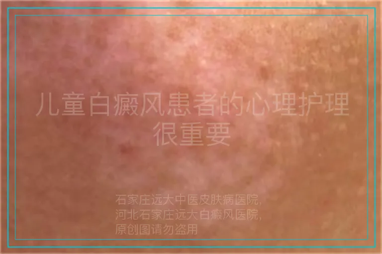 儿童白癜风患者的心理护理很重要