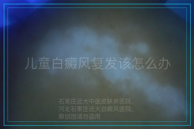 儿童白癜风复发该怎么办