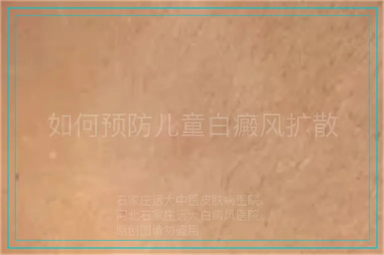 如何预防儿童白癜风扩散