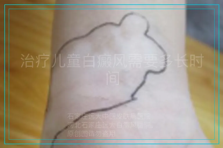 治疗儿童白癜风需要多长时间