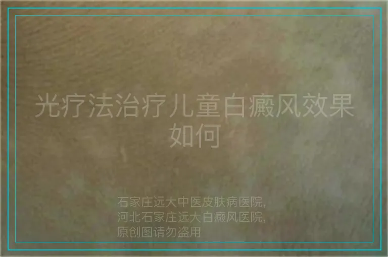 光疗法治疗儿童白癜风效果如何