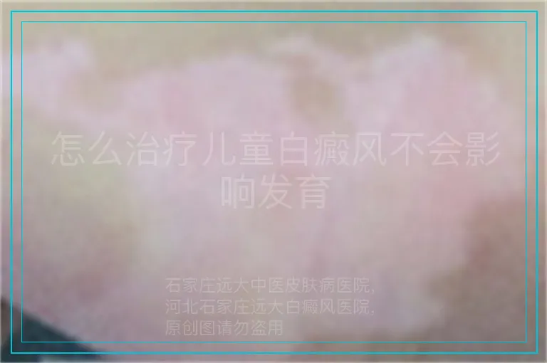 怎么治疗儿童白癜风不会影响发育