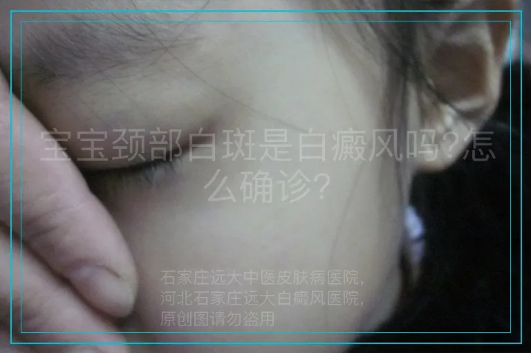 宝宝颈部白斑是白癜风吗?怎么确诊?