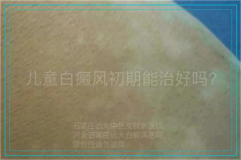 儿童白癜风初期能治好吗?