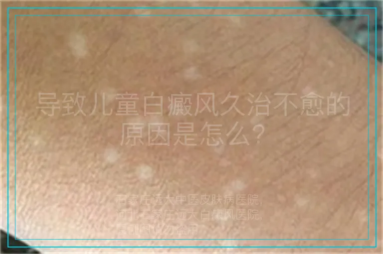 导致儿童白癜风久治不愈的原因是怎么?
