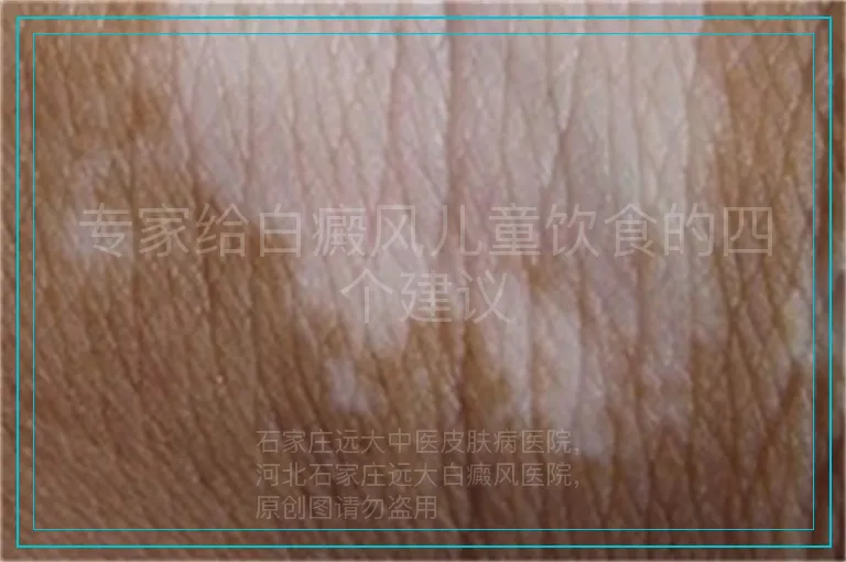 专家给白癜风儿童饮食的四个建议