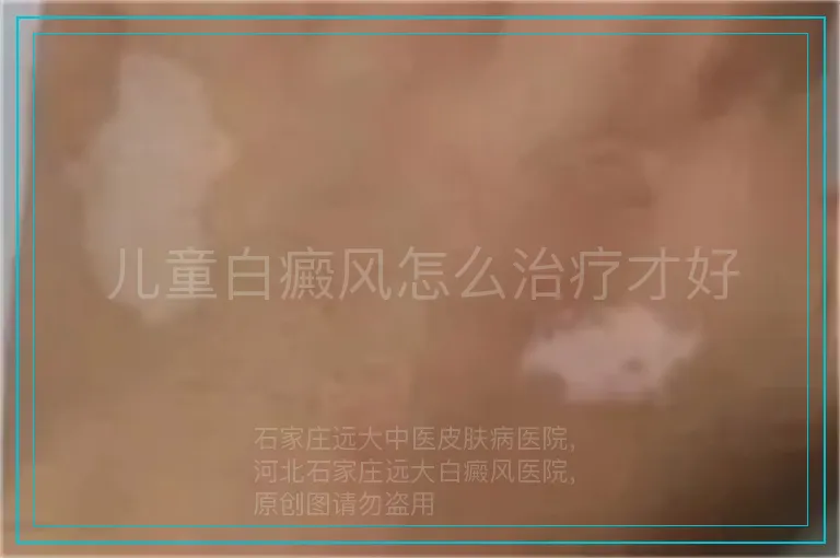 儿童白癜风怎么治疗才好