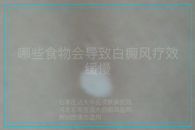 哪些食物会导致白癜风疗效缓慢