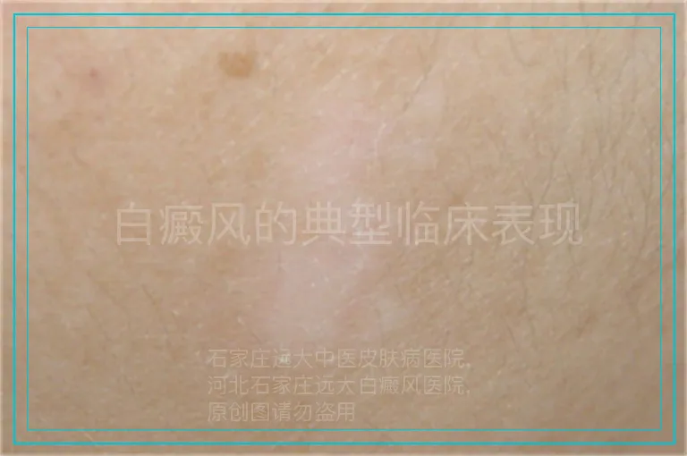 白癜风的典型临床表现