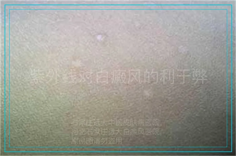 紫外线对白癜风的利于弊