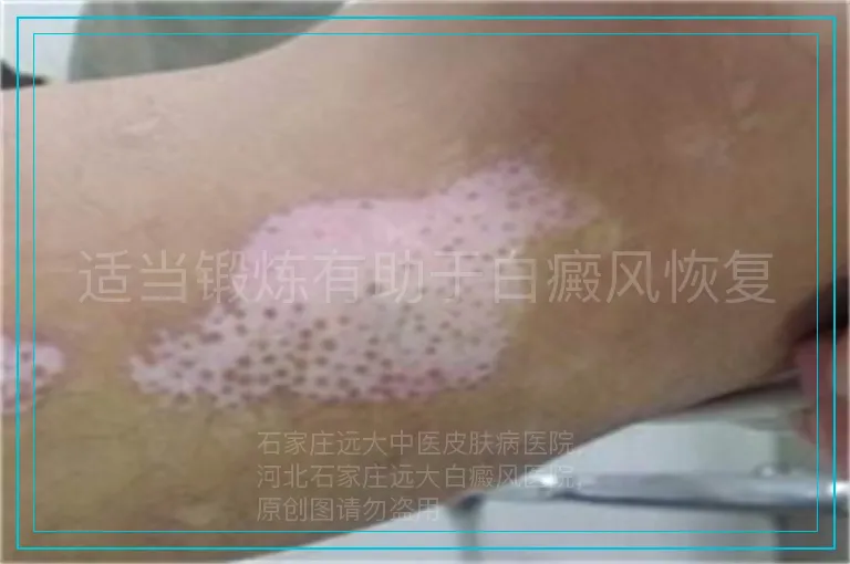 适当锻炼有助于白癜风恢复