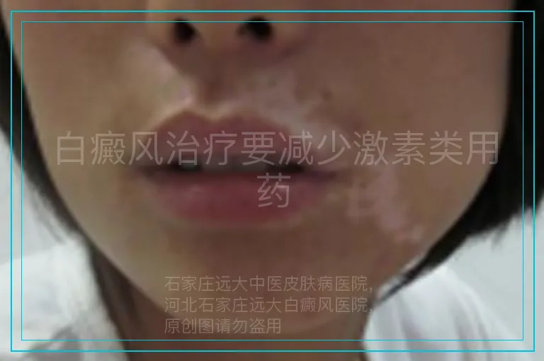 白癜风治疗要减少激素类用药